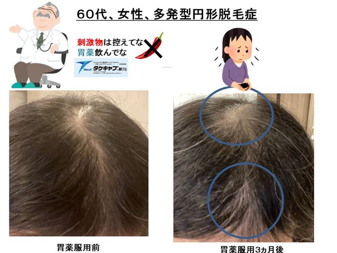 円形脱毛症　病院